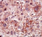 IHC analysis of FFPE human hepatocarcinoma stained with the GAK antibody