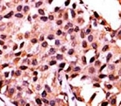 IHC analysis of FFPE human breast carcinoma stained with the PPP3CC antibody