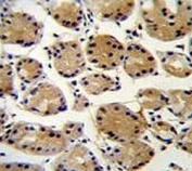 FAT10 antibody immunohistochemistry analysis in formalin fixed and paraffin embedded human stomach carcinoma.