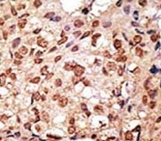 IHC analysis of FFPE human breast carcinoma stained with the SIGLEC7 antibody