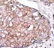 IHC analysis of FFPE human hepatocarcinoma stained with the SIGLEC7 antibody