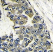 IHC analysis of FFPE human breast carcinoma stained with EIF4B antibody