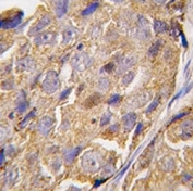IHC analysis of FFPE human breast carcinoma tissue stained with EIF4B antibody