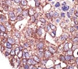 IHC analysis of FFPE human breast carcinoma tissue stained with the SYVN1 antibody