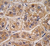 IHC analysis of FFPE human hepatocarcinoma tissue stained with AKR1A1 antibody