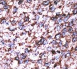 IHC analysis of FFPE human hepatocarcinoma stained with the BACE2C antibody