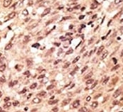 IHC analysis of FFPE human hepatocarcinoma stained with the LRP5 antibody