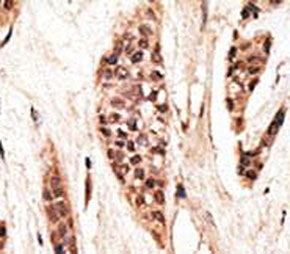 IHC analysis of FFPE human breast carcinoma tissue stained with the TAP1 antibody~