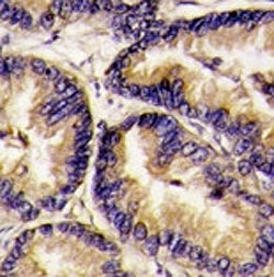 IHC analysis of FFPE human lung carcinoma tissue stained with VEGFB antib