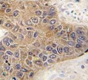 IHC analysis of FFPE human hepatocarcinoma tissue stained with STUB1 antibody