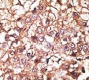 IHC analysis of FFPE human hepatocarcinoma stained with the STUB1 antibody