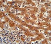 PKM2 antibody immunohistochemistry analysis in formalin fixed and paraffin embedded human hepatocarcinoma.