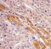 IHC analysis of FFPE human hepatocarcinoma tissue stained with PGK1 antibody