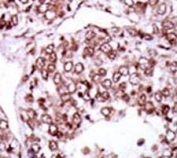 IHC analysis of FFPE human hepatocarcinoma stained with the CAMK2G antibody
