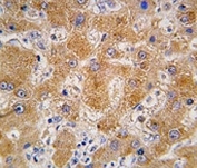 IHC analysis of FFPE human hepatocarcinoma tissue stained with APOA4 antibody.