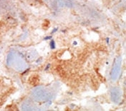 cKit antibody was used in immunohistochemistry on breast carcinoma.
