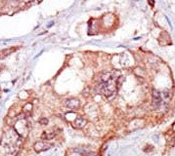 IHC analysis of FFPE human breast carcinoma tissue stained with the TNK1 antibody