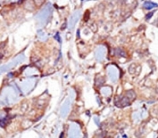 IHC analysis of FFPE human breast carcinoma tissue stained with the MYLK3 antibody