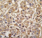 IHC analysis of FFPE human breast carcinoma tissue stained with MYLK3 antibody