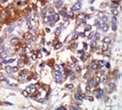 IHC analysis of FFPE human hepatocarcinoma stained with the cGKI beta antibody