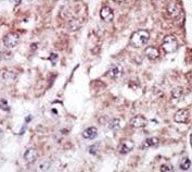 IHC analysis of FFPE human hepatocarcinoma stained with the MARK2 antibody