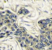 IHC analysis of FFPE human breast carcinoma stained with PI3KCA antibody