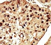 IHC analysis of FFPE human hepatocarcinoma stained with the TRPM7 antibody