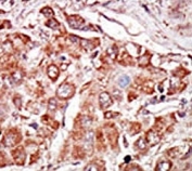 IHC analysis of FFPE human hepatocarcinoma stained with the PKR antibody