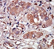 IHC analysis of FFPE human hepatocarcinoma stained with the PRKR antibody