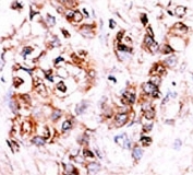 IHC analysis of FFPE human hepatocarcinoma stained with the DUSP15 antibody