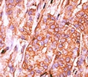 IHC analysis of FFPE human breast carcinoma tissue stained with the CTDSP2 antibody
