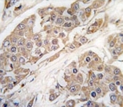 IHC analysis of FFPE human breast carcinoma tissue stained with CTDSP2 antibody