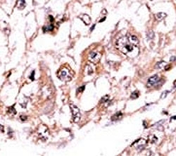 IHC analysis of FFPE human hepatocarcinoma stained with the PPP3CC antibody~