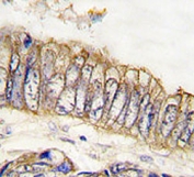 IHC analysis of FFPE human colon carcinoma tissue stained with MET antibody