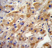 MET antibody immunohistochemistry analysis in formalin fixed and paraffin embedded human hepatocarcinoma.