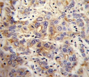 MET antibody immunohistochemistry analysis in formalin fixed and paraffin embedded human hepatocarcinoma.