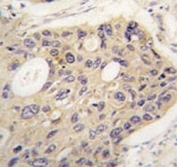IHC analysis of FFPE human lung carcinoma tissue stained with ATG12 antibody