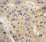 IHC analysis of FFPE human hepatocarcinoma tissue and lung carcinoma tissue stained with ATG12 antibody