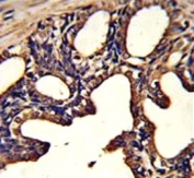 IHC analysis of FFPE human prostate carcinoma tested with LTF antibody