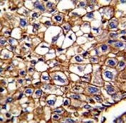 IHC analysis of FFPE human hepatocarcinoma tested with CD34 antibody