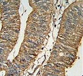 ALDH1A1 antibody immunohistochemistry analysis in formalin fixed and paraffin embedded human colon carcinoma.