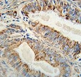 Anti-AKT2 antibody immunohistochemistry analysis in formalin fixed and paraffin embedded human prostate carcinoma.