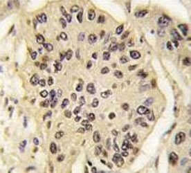 IHC analysis of FFPE human lung carcinoma tissue stained with SOX2 antibody