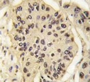 IHC analysis of FFPE human lung carcinoma tissue stained with SOX2 antibody.