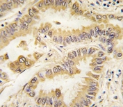 IHC analysis of FFPE human lung carcinoma tissue stained with SOD2 antibody