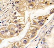 IHC analysis of FFPE human lung carcinoma tissue stained with EPHB2 antibody