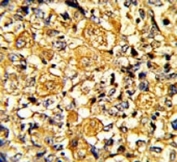 IHC analysis of FFPE human breast carcinoma with EGFR antibody