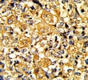 IHC analysis of FFPE human breast carcinoma with EGFR antibody