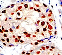IHC analysis of FFPE human breast carcinoma tissue stained with the PRMT1 antibody~