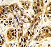 IHC analysis of FFPE human breast carcinoma tissue stained with PRMT1 antibody